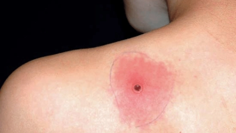 Cowpox in humans needs diagnosis