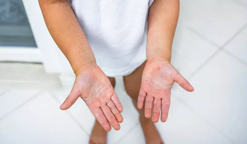 A timeline of how long hand foot mouth lasts