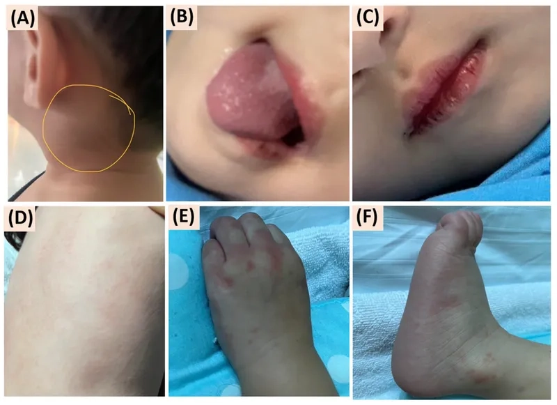 A child with hand foot and mouth disease symptoms