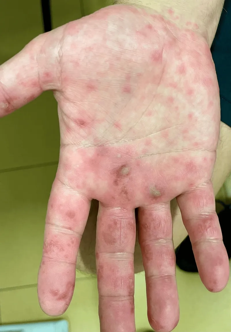 A medical professional discusses treatment for coxsackievirus