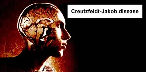 Recognizing Creutzfeldt Jakob disease symptoms