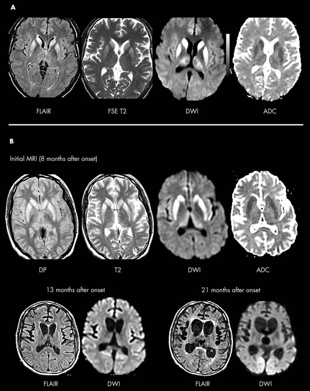 Recognizing Creutzfeldt Jakob disease symptoms