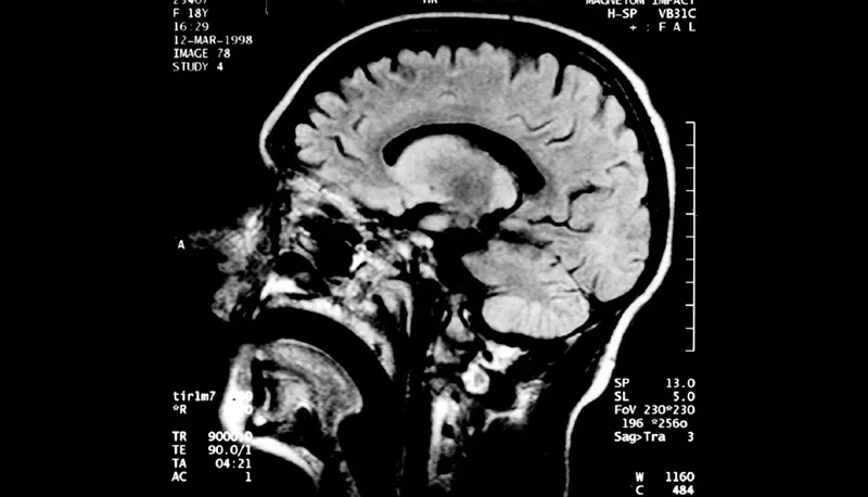 Explaining what causes Creutzfeldt Jakob disease