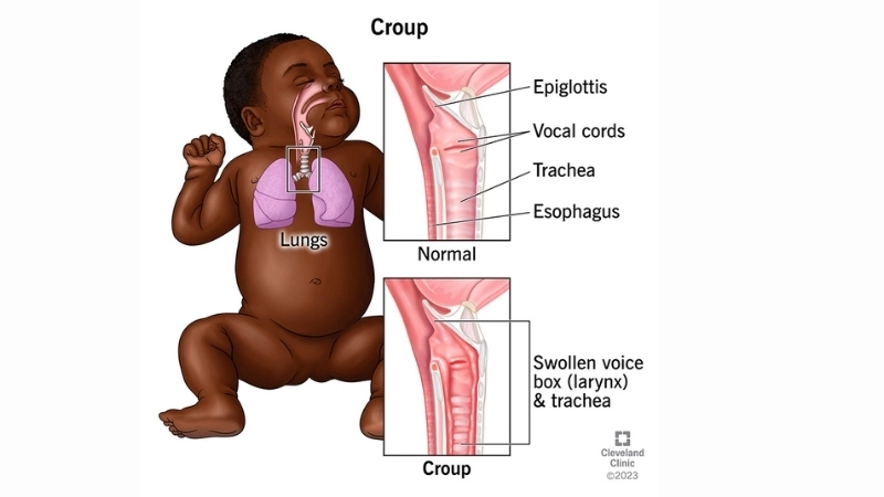 Croup visual guide with adenovirus rash cases