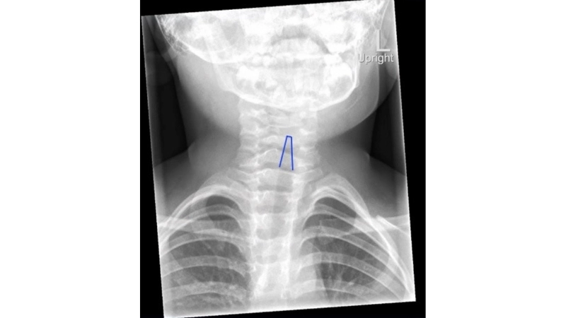Croup images showing adenovirus cold effects clearly