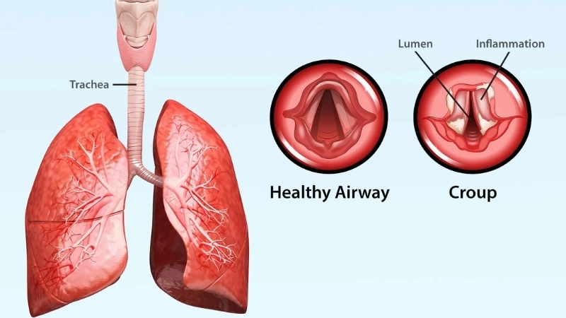 Prevent croup using adenovirus vaccine safely