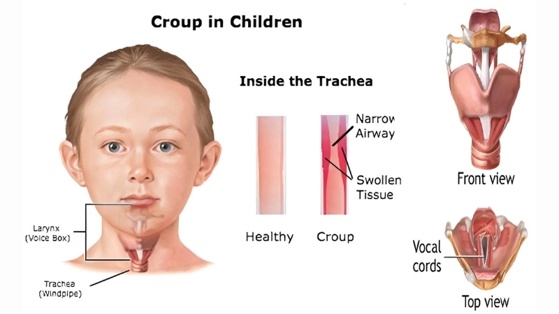 Croup cases with adenovirus conjunctivitis signs