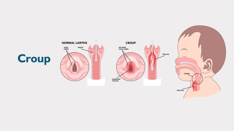 See croup linked to adenovirus pneumonia issues