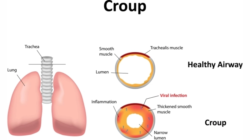 How croup is contagious through respiratory droplets