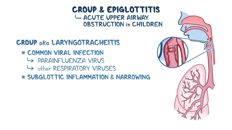 Croup in infants caused by adenovirus in infants
