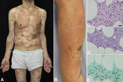A visual guide to recognizing Cryptococcosis symptoms