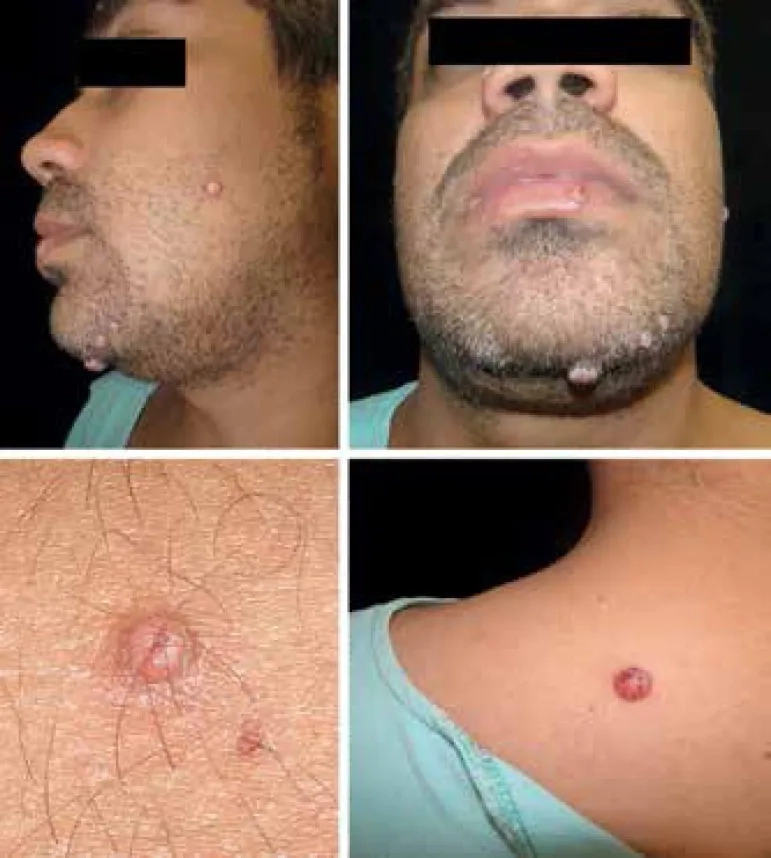 An overview of Cryptococcus neoformans treatment options