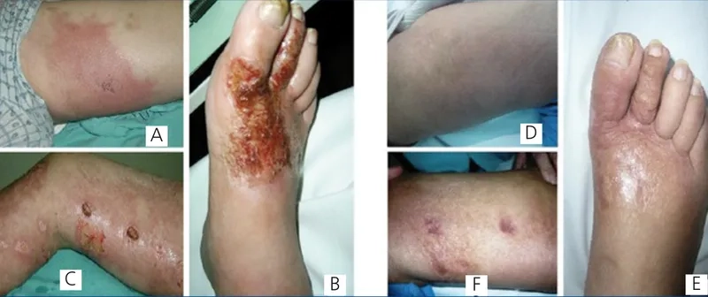 The impact of Cryptococcosis in HIV patients