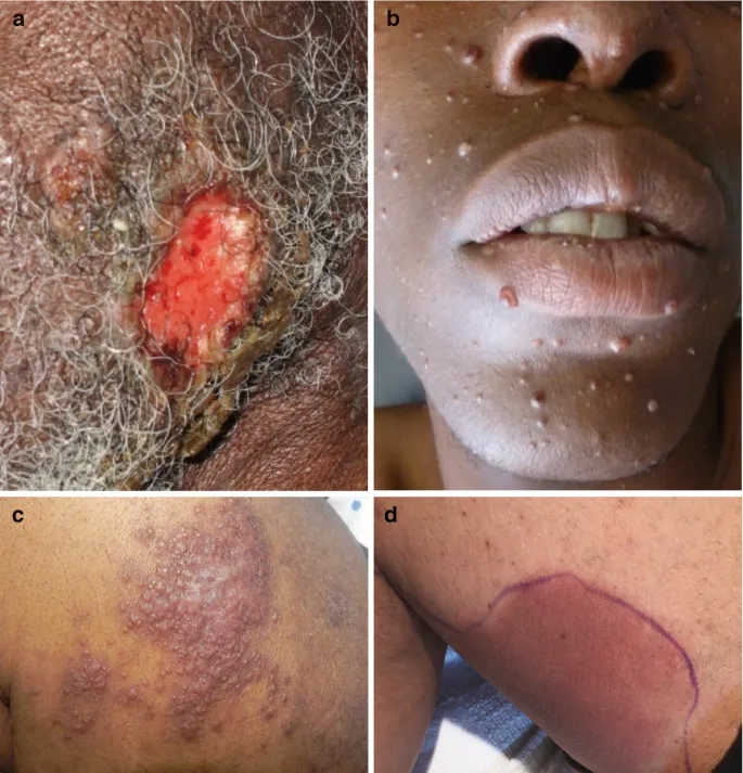 Explaining the transmission of Cryptococcosis