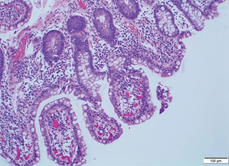 The main symptom: watery diarrhea crypto