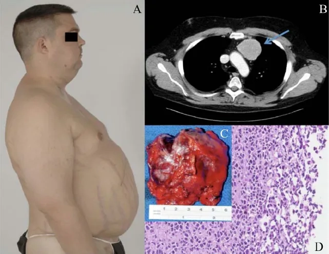 Infographic illustrating what is Cushing's syndrome