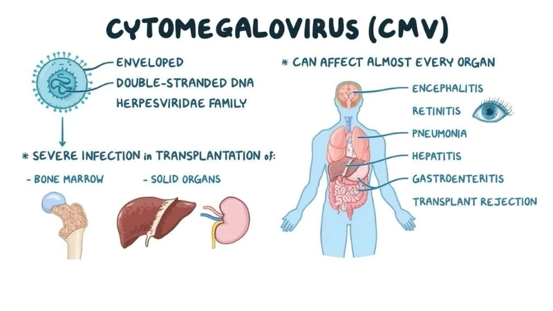 Cytomegalovirus (CMV) Infection cytomegalovirus symptoms