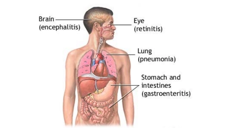 Cytomegalovirus (CMV) Infection congenital cmv