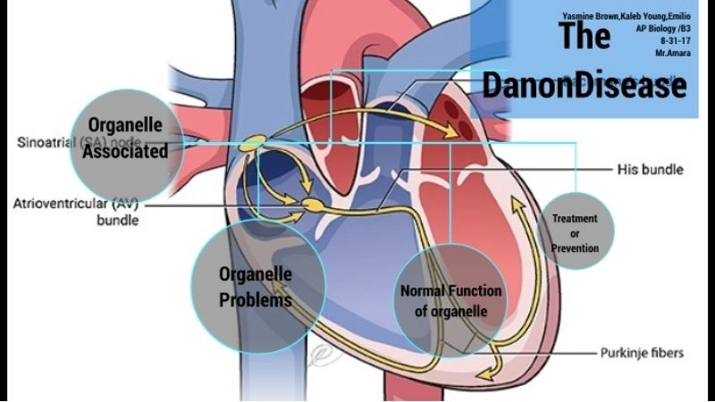 Danon disease treatment managing symptoms and heart health