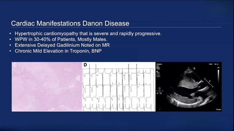 Danon disease and cardiomyopathy heart complications from disease