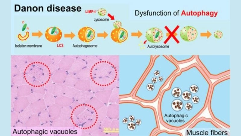 Living with danon disease daily life and heart management