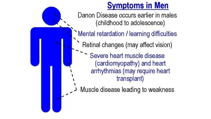 Danon disease in males more severe heart involvement risks