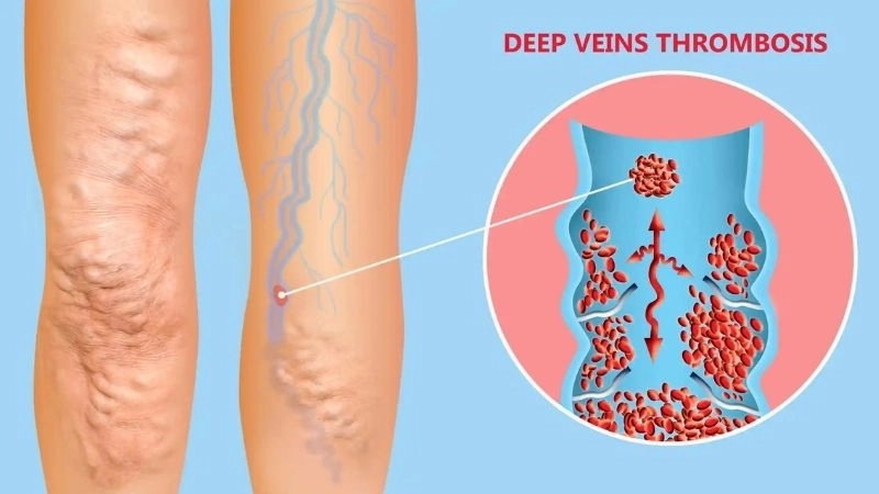 DVT symptoms that should never be ignored