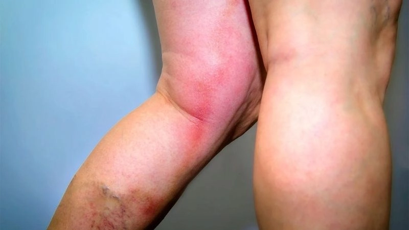 DVT causes and contributing health conditions