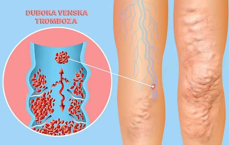A medical illustration of what is DVT