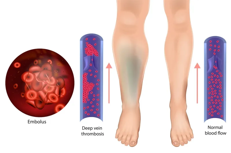Recognizing the most common DVT symptoms