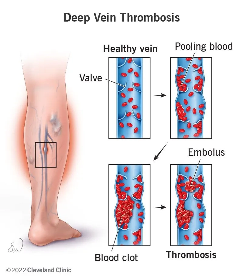The effects of post-thrombotic syndrome