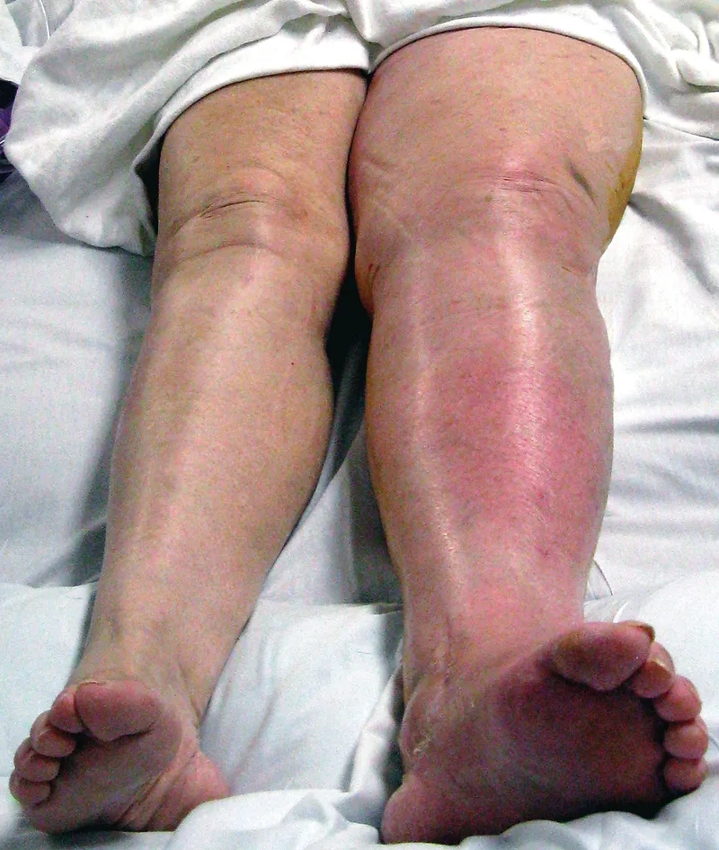 Identifying the key risk factors for DVT