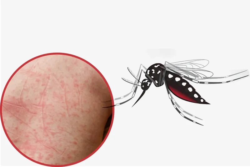 Charting the dengue platelet count recovery process