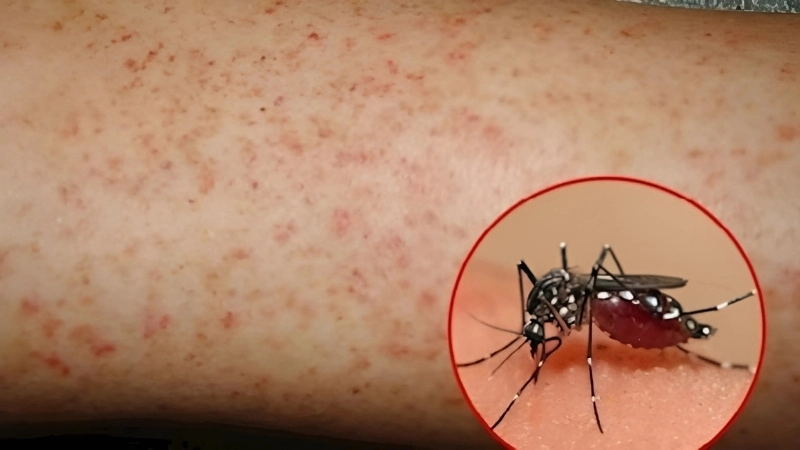 Avoid bites from Aedes mosquito to stay safe