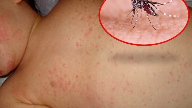 Red spots signal Dengue fever rash clearly