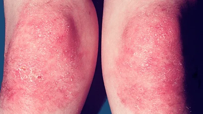 A clear view of a heliotrope rash on the eyelids