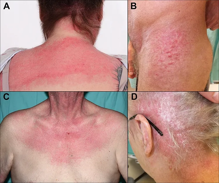 A diagram of progressive muscle weakness