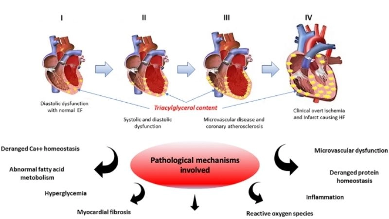 Diabetic cardiomyopathy and high blood pressure added risk factor