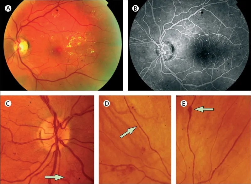 Advanced stage of proliferative diabetic retinopathy