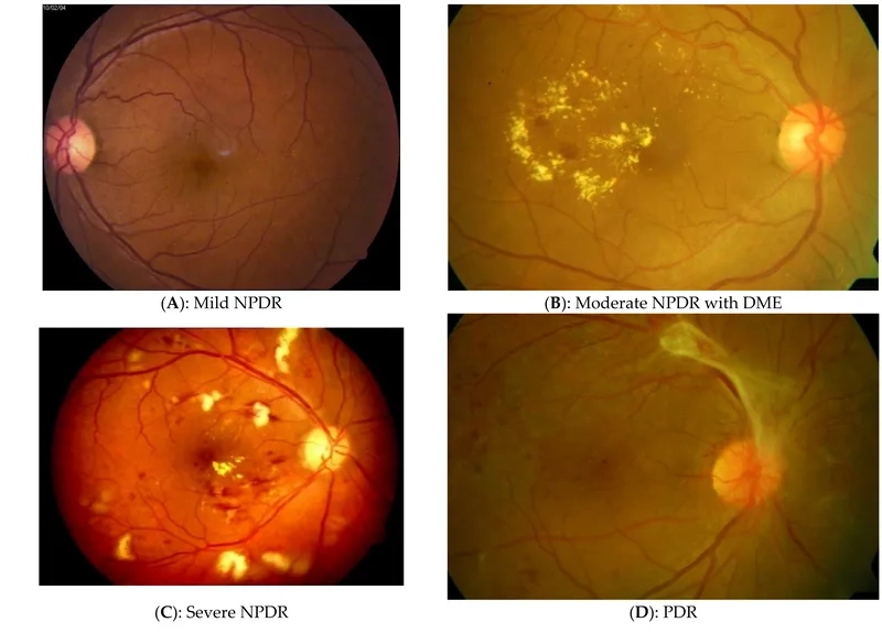 Chart explaining if can diabetic retinopathy be reversed