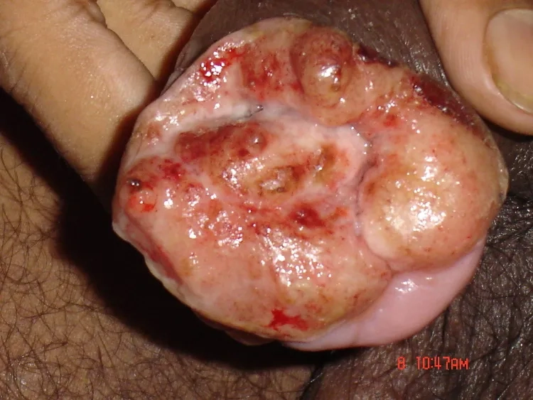 An effective treatment for donovanosis