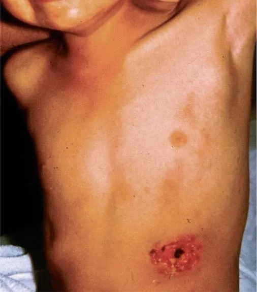 Clinical granuloma inguinale pictures