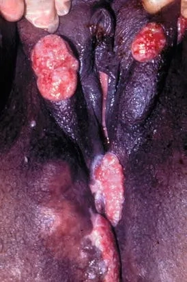 A clear explanation of what is donovanosis