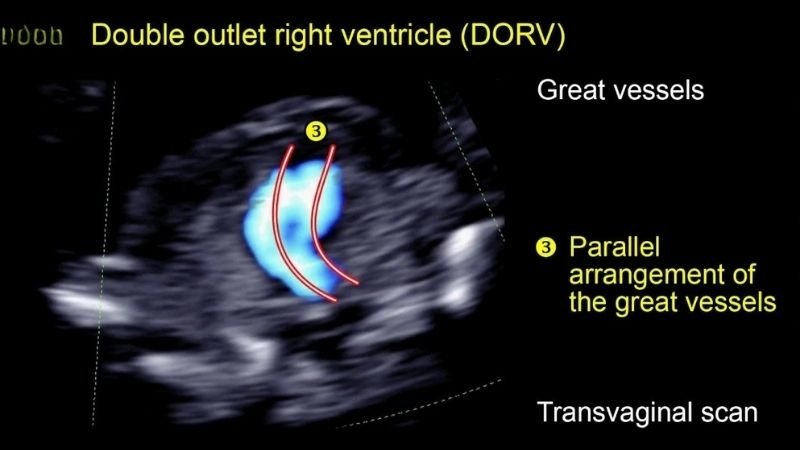 Double outlet right ventricle and ventricular septal defect link