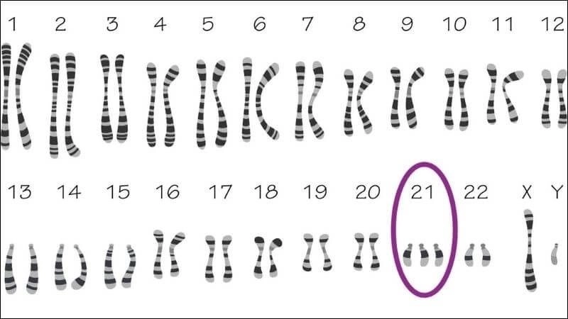 Atrioventricular septal defect in Down syndrome