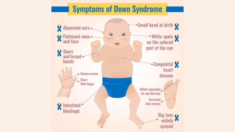 Atrial septal defect in children with Down syndrome
