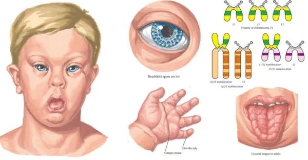 Down syndrome symptoms and early health indicators