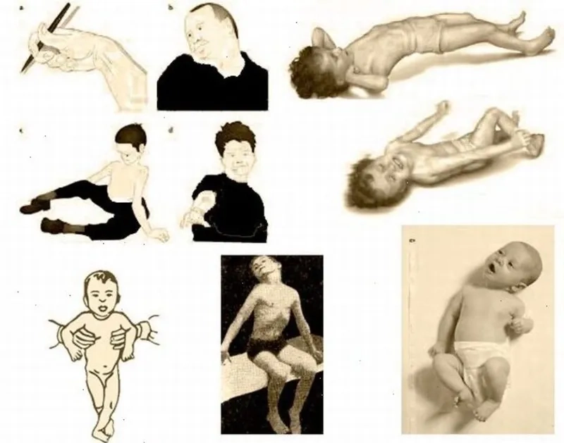 How botox for dystonia is administered