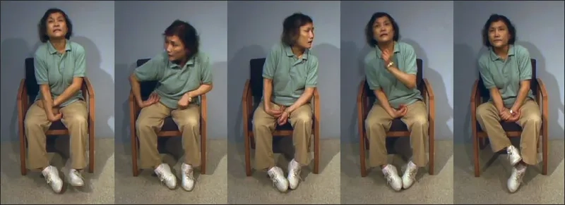 A patient demonstrating focal dystonia in the hand