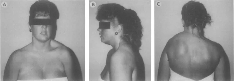 A patient with spasmodic torticollis before treatment